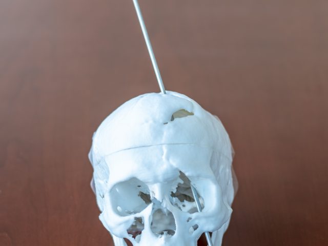 3D-Printed Skull of Phineas Gage
